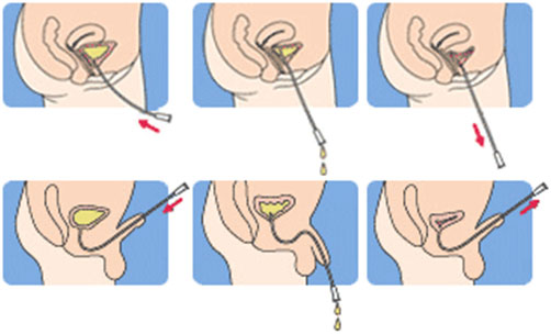 catheterisation 