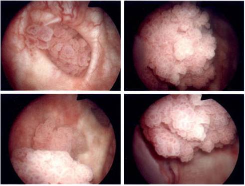 bladder cancer inside view