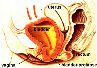 bladder-prolapse